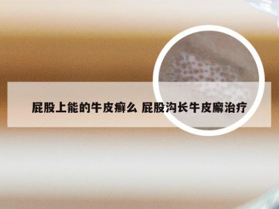 屁股上能的牛皮癣么 屁股沟长牛皮廨治疗
