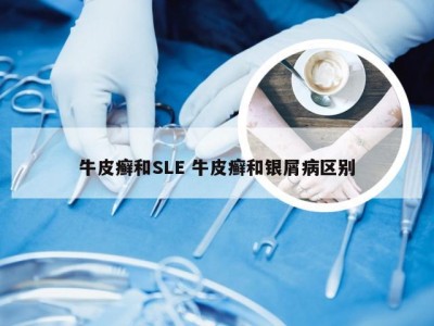 牛皮癣和SLE 牛皮癣和银屑病区别