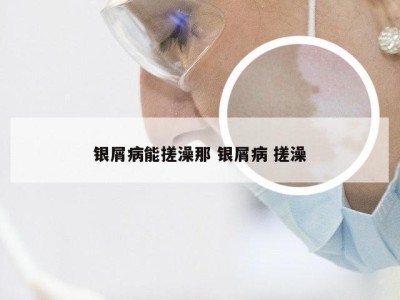 银屑病能搓澡那 银屑病 搓澡