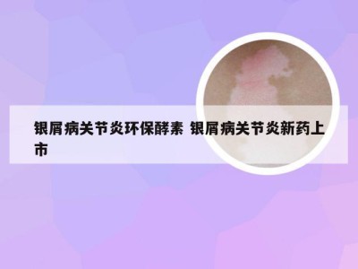 银屑病关节炎环保酵素 银屑病关节炎新药上市