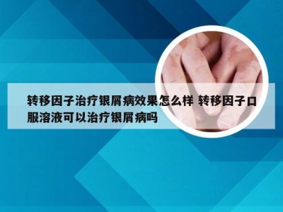 转移因子治疗银屑病效果怎么样 转移因子口服溶液可以治疗银屑病吗