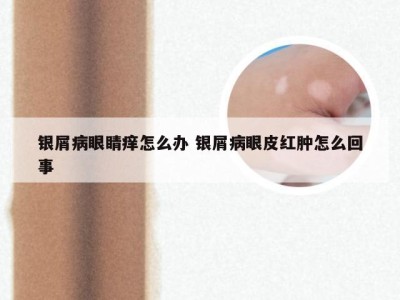 银屑病眼睛痒怎么办 银屑病眼皮红肿怎么回事