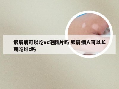 银屑病可以吃vc泡腾片吗 银屑病人可以长期吃维c吗