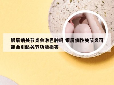 银屑病关节炎会淋巴肿吗 银屑病性关节炎可能会引起关节功能损害