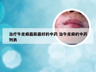 治疗牛皮癣最新最好的中药 治牛皮癣的中药列表