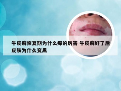 牛皮癣恢复期为什么痒的厉害 牛皮癣好了后皮肤为什么变黑