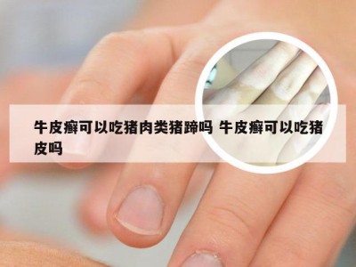 牛皮癣可以吃猪肉类猪蹄吗 牛皮癣可以吃猪皮吗