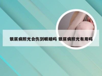 银屑病照光会伤到眼睛吗 银屑病照光有用吗