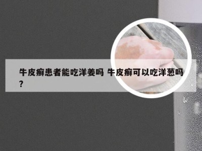 牛皮癣患者能吃洋姜吗 牛皮癣可以吃洋葱吗?