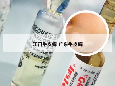 江门牛皮癣 广东牛皮癣