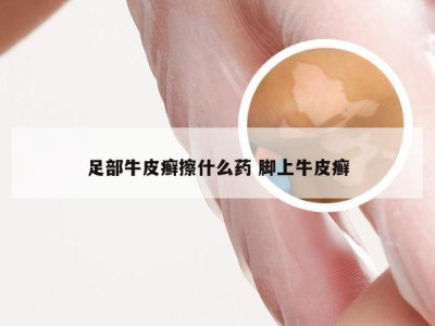 足部牛皮癣擦什么药 脚上牛皮癣
