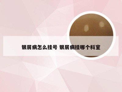 银屑病怎么挂号 银屑病挂哪个科室