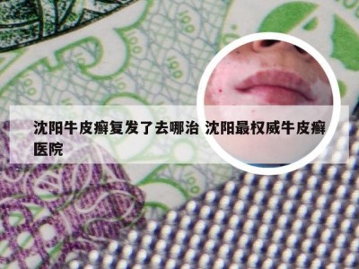 沈阳牛皮癣复发了去哪治 沈阳最权威牛皮癣医院