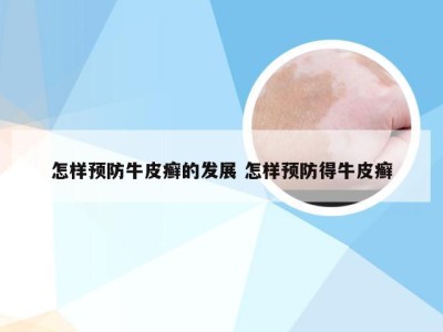 怎样预防牛皮癣的发展 怎样预防得牛皮癣