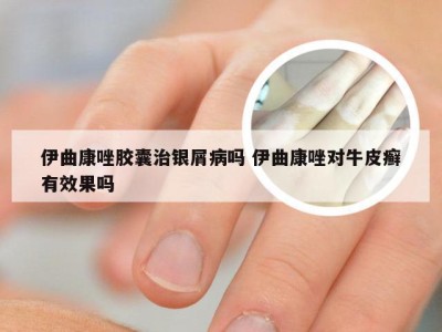 伊曲康唑胶囊治银屑病吗 伊曲康唑对牛皮癣有效果吗