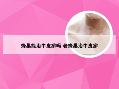 蜂巢能治牛皮癣吗 老蜂巢治牛皮癣