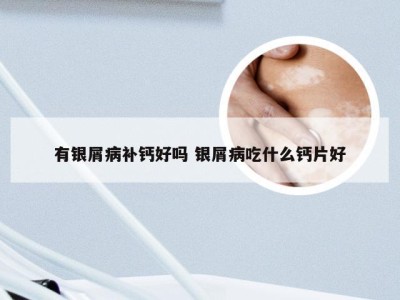 有银屑病补钙好吗 银屑病吃什么钙片好