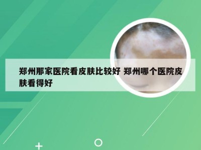 郑州那家医院看皮肤比较好 郑州哪个医院皮肤看得好