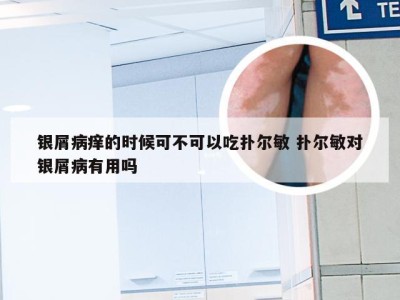 银屑病痒的时候可不可以吃扑尔敏 扑尔敏对银屑病有用吗