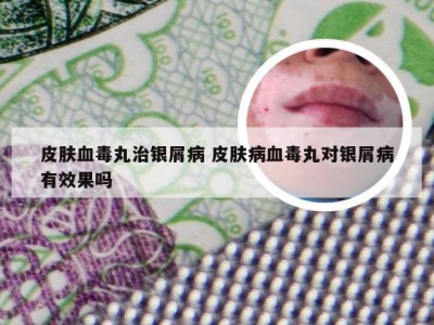 皮肤血毒丸治银屑病 皮肤病血毒丸对银屑病有效果吗