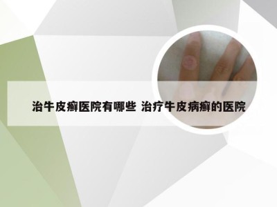 治牛皮癣医院有哪些 治疗牛皮病癣的医院