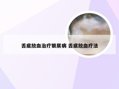 舌底放血治疗银屑病 舌底放血疗法