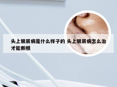 头上银屑病是什么样子的 头上银屑病怎么治才能断根