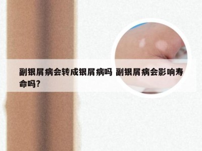 副银屑病会转成银屑病吗 副银屑病会影响寿命吗?