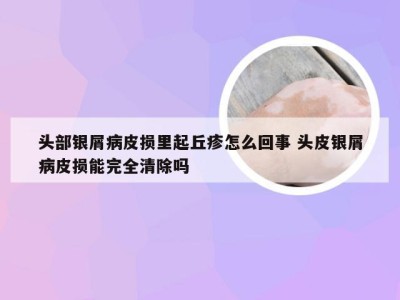 头部银屑病皮损里起丘疹怎么回事 头皮银屑病皮损能完全清除吗