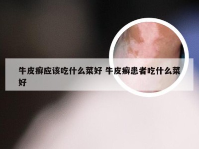 牛皮癣应该吃什么菜好 牛皮癣患者吃什么菜好