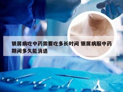 银屑病吃中药需要吃多长时间 银屑病服中药期间多久能消退
