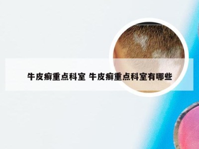 牛皮癣重点科室 牛皮癣重点科室有哪些