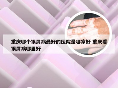 重庆哪个银屑病最好的医院是哪家好 重庆看银屑病哪里好