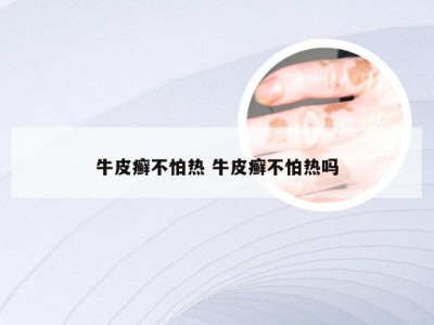 牛皮癣不怕热 牛皮癣不怕热吗