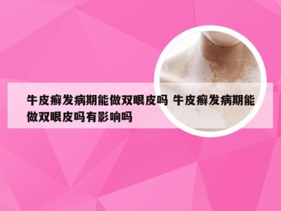 牛皮癣发病期能做双眼皮吗 牛皮癣发病期能做双眼皮吗有影响吗