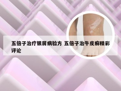 五倍子治疗银屑病验方 五倍子治牛皮癣精彩评论