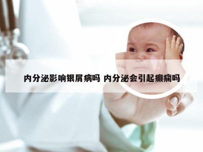 内分泌影响银屑病吗 内分泌会引起癫痫吗