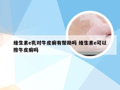 维生素e乳对牛皮癣有帮助吗 维生素e可以擦牛皮癣吗