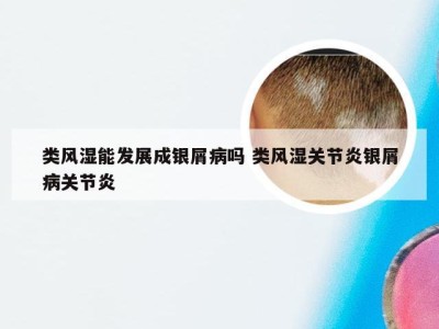 类风湿能发展成银屑病吗 类风湿关节炎银屑病关节炎
