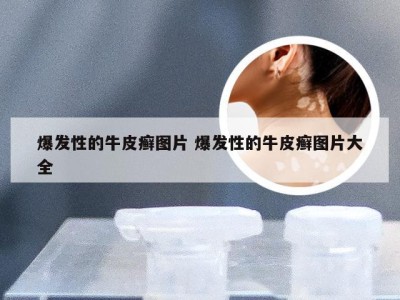 爆发性的牛皮癣图片 爆发性的牛皮癣图片大全