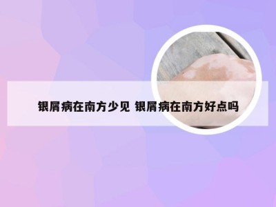 银屑病在南方少见 银屑病在南方好点吗