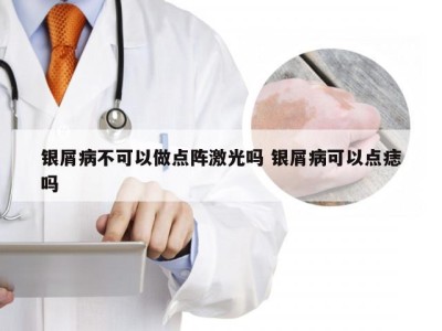 银屑病不可以做点阵激光吗 银屑病可以点痣吗