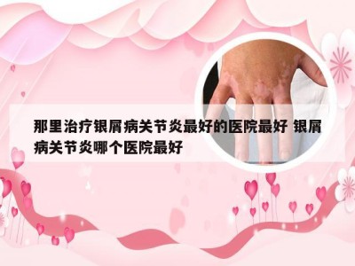 那里治疗银屑病关节炎最好的医院最好 银屑病关节炎哪个医院最好