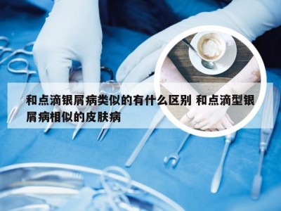和点滴银屑病类似的有什么区别 和点滴型银屑病相似的皮肤病