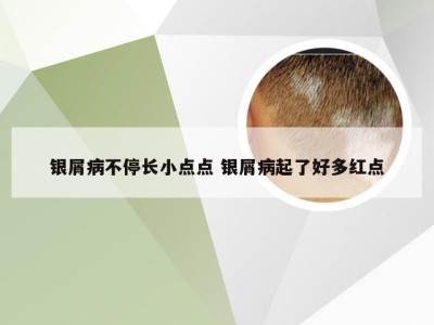 银屑病不停长小点点 银屑病起了好多红点