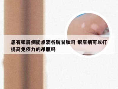 患有银屑病能点滴谷胱甘肽吗 银屑病可以打提高免疫力的吊瓶吗