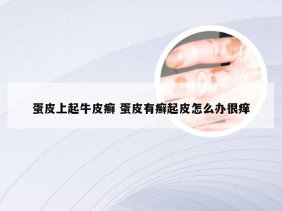 蛋皮上起牛皮癣 蛋皮有癣起皮怎么办很痒