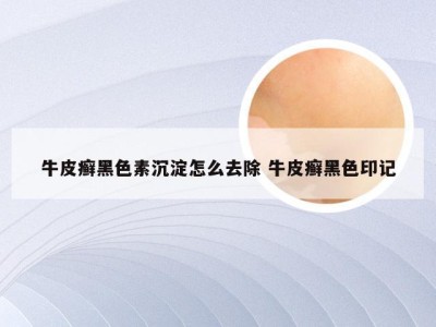 牛皮癣黑色素沉淀怎么去除 牛皮癣黑色印记