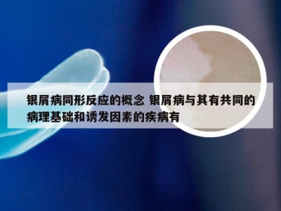 银屑病同形反应的概念 银屑病与其有共同的病理基础和诱发因素的疾病有