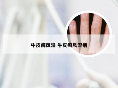 牛皮癣风湿 牛皮癣风湿病